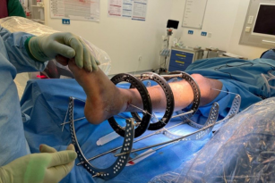 Limb reconstruction with metal brace support