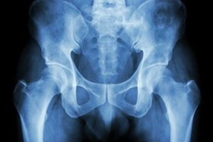An x-ray image of a pelvis