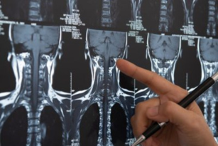 A finger pointing to an x-ray image of a spine