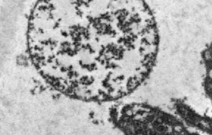 Platelet swollen into balloon structure next to normal platelets