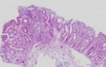 Small intestinal biopsy from child with refractory stunting