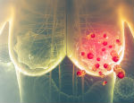 Illustration of breast cancer cells