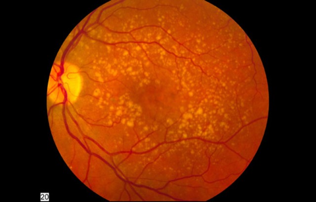 A photo showing intermediate age-related macular degeneration. Credit: National Institutes of Health