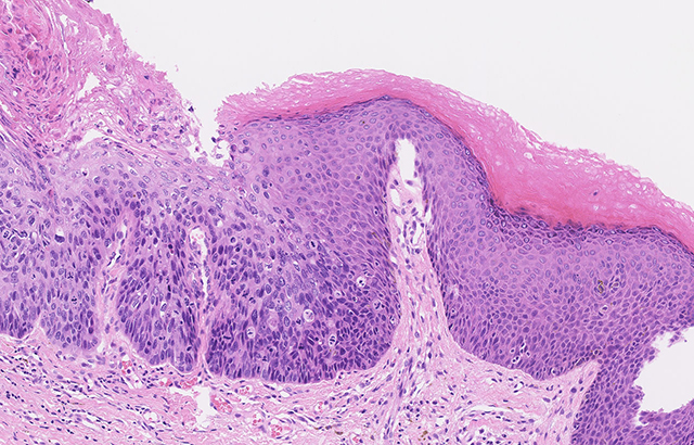 Microscope image of abnormal cells within the anus