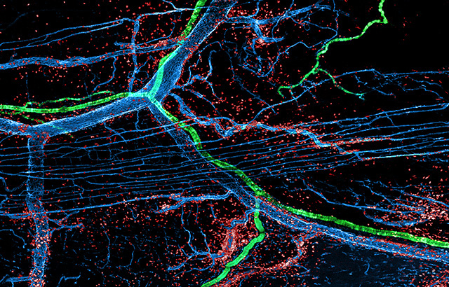 'An inflammatory storm' by Dr Tamara Girbl, QMUL 