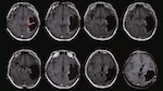 MRI brain scans of one of the trial participants who achieved a complete response. See original paper for more details. © Ning, W. et al. 2024 CC-BY 4.0