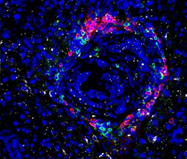 Pancreatic cancer cells being infiltrated by immune cells