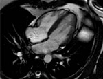 An MRI scan of the heart