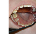 Image of glass cement fillings, copyright Semmelweis University Dental School