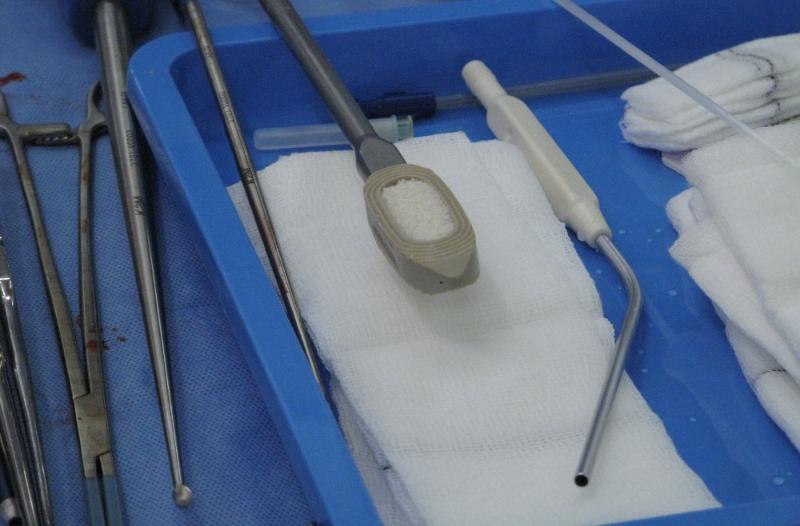 Inductigraft™ packed into a vertebral spacer