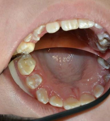 Image of glass cement fillings, copyright Semmelweis University Dental School