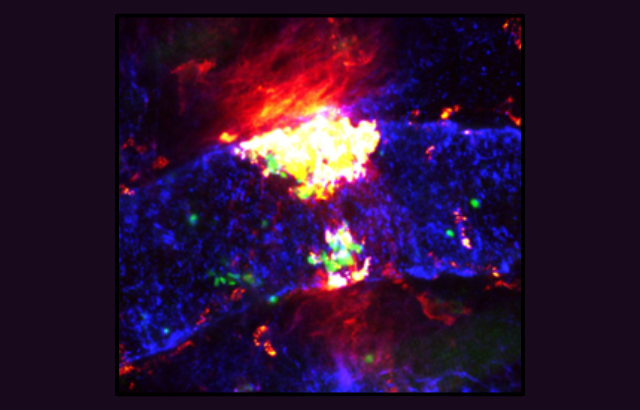 Image:  A Portrait of a Fiery Blood Clot, Credit: Sammy El-Mansi, Queen Mary University of London, British Heart Foundation - Reflections of Research